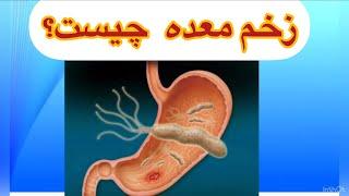 زخم معده چيست و چگونه ايجاد مى شود؟ what ist gastric ulcer