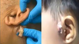 ВЫДАВЛИВАНИЕ ОГРОМНЫХ ПРЫЩЕЙ ЗА УХОМ ПРЫЩИ УГРИ Super Pimple Popping Compilation