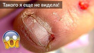Очень Обгрызенные ногти  Проблемная кутикула - Маникюр и Наращивание