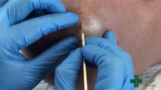 Removal of a Pilar Cyst essentially intact with mild extrusion