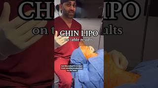 INSANE Chin Lipo RESULTS#chinliposuction #chinlipo #glowup #jawline #beforeandafter
