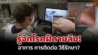 รู้จัก ฝีดาษลิง อาการ การติดต่อ วิธีการรักษา  อมรินทร์อัปเดต