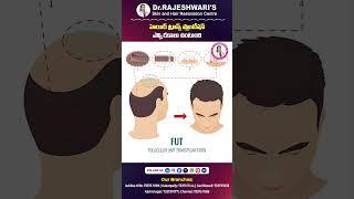 Types of Hair Transplant Methods  Types of Hair Transplant in India  #shorts #ytshorts