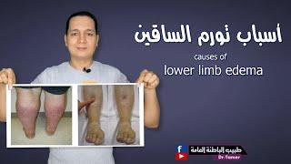 أسباب تورم الساقين  causes of lower limb edema