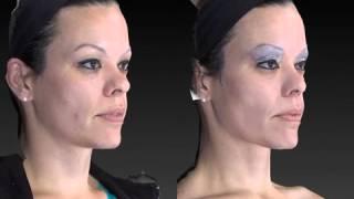 Rhinoplasty 3D Before and After-20