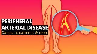 Peripheral vascular disease Causes Signs and Symptoms Diagnosis and Treatment.