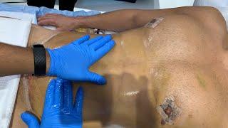 MALE SIX PACK HD-LIPO POST-OP LYMPHATIC DRAINAGE MASSAGE  West Hollywood CA  Dr. Jason Emer