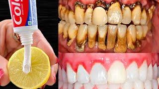 2 मिनट में गंदे पीले दांतों को मोतियों की तरह सफ़ेद और चमकदार बना देगा ये नुस्ख़ा Teeth Whitening