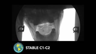 Unstable C1-C2 and Stable C1-C2 under Digital Motion X-ray