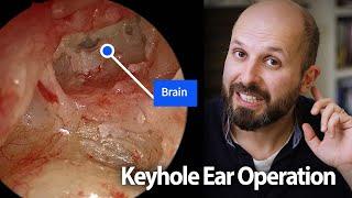 Watch an ear operation mastoidectomy