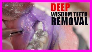 Wisdom Teeth Removal  Tooth Sectioning Procedure. Surgical Guide + Online Courses