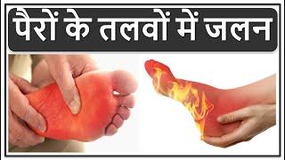 पैरों के तलवों में जलन का इलाज पैरों में जलन होने से कौन सी बीमारी होती है? Burning Feet Treatment