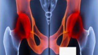 Chronic Pelvic Pain  Usapang Pangkalusuga