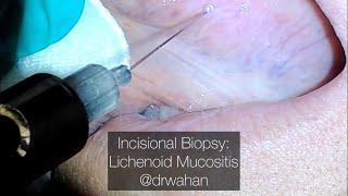 Lichenoid Mucositis of the Tongue Incisonal Biopsy Step by Step