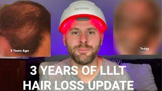 3 Years Of Using Low Level Laser Therapy LLLT For Hair Loss - My Results.