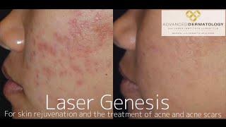 Laser Genesis Treatment at Advanced Dermatology & Laser Institute of Seattle