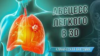 Абсцесс лёгкого в 3D. Клиническая анатомия