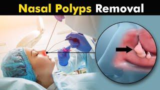 Nasal Polyps and their treatment   How Polypectomy is Performed? UrduHindi