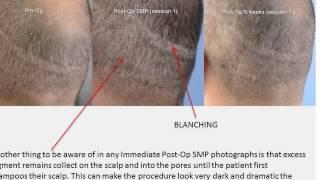 Scalp Micropigmentation Excellent Results by Shapiro Medical Group