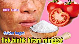 DOKTER KAGETFLEK DAN BINTIK HITAM HILANG CUMA DENGAN TOMAT DAN GARAM