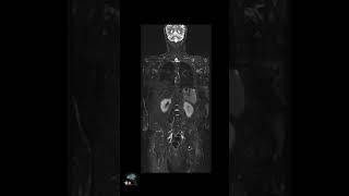 MRI – Whole Body Imaging wDeep Resolve