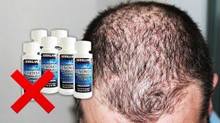 Dont Use MINOXIDIL Before Watching This – It Does NOT Prevent Hair Loss