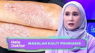 Masalah Kulit Psoriasis  Helo Doktor 26 Nov 2023