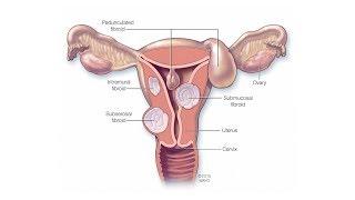 Mayo Clinic Minute 4 myths about fibroids