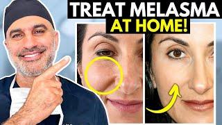 What you NEED to know about treating Melasma AT HOME the RIGHT way