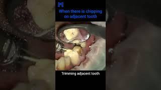 Trouble shooting  When chipping is found on adjacent tooth