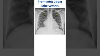 Prominent upper lobe vessels