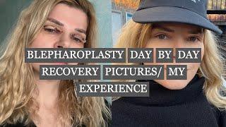 BLEPHAROPLASTY AND UPPER EYELID SURGERY RECOVERY BEFORE&AFTER MY EXPERIENCE