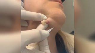Popping huge blackheads and Giant Pimples - Best Pimple Popping Videos #138