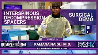 Interspinous Decompression Spacers - Ramana Naidu MD