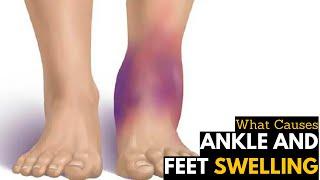 What Causes Ankles & Feet Swelling  Diagnosis & Treatment