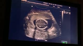 19 Weeks Pregnant Gender Reveal Sonogram Anatomy Scan Doctor Appointment