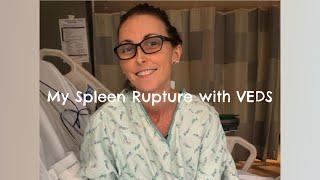 My Spleen Rupture with VEDS Vascular Ehlers-Danlos syndrome