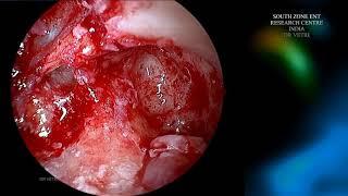 CHOLESTEATOMA MAEAES MICROSCOPE AND ENDOSCOPE ASSISTED EAR SURGERY