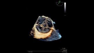 En Face View of Quadricuspid Aortic Valve