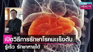 โรคมะเร็งตับ เปิดวิธีการรักษา รู้เร็ว รักษาหายได้ เพื่อความหวังของผู้ป่วย  l TNN HEALTH l 03 09 65