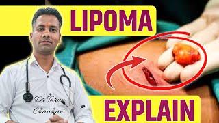  LIPOMA IS CANCR ? CHARBI KI GANTH  Dr tarun