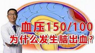 血压150.100，却发生了脑出血，原因是什么？医生说出其中原因