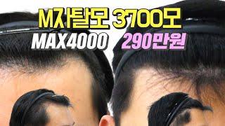 M자탈모 모발이식비용 290만원 MAX4000   3700모 이식 전 후