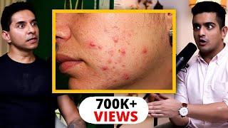 Heal Adult Acne Forever - Accutane Cortisol & Diet Guidelines By Luke Coutinho