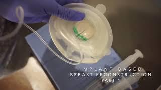 Breast Reconstruction After Mastectomy with Tissue Expanders - Dr. Amaka explains the process