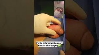 Penile Enlargement Surgery - Results after surgery - Dr. Araz Bayramov - penilenlargement.com
