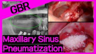 Online Surgery Sinus bone graft & augmentation GBR on extremely pneumatized maxillary sinus