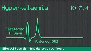 Master ECG Spot Potassium Abnormalities from Hypo to Hyperkalemia