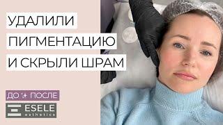 КАК УДАЛИТЬ ПИГМЕНТАЦИЮ? ЧТО ТАКОЕ КАМУФЛЯЖ ШРАМОВ?