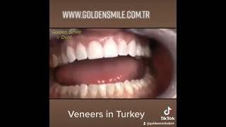Veneers in Turkey